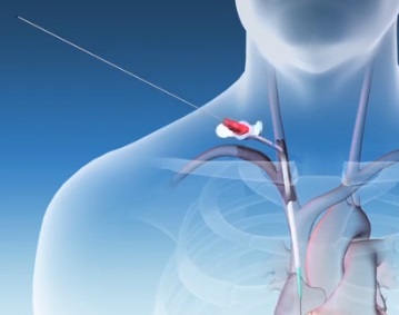 The Surfacer inside-out catheter system from Merit Medical Systems, Inc